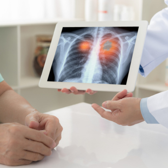 Skrining je ključan: Prepoznajte simptome karcinoma pluća