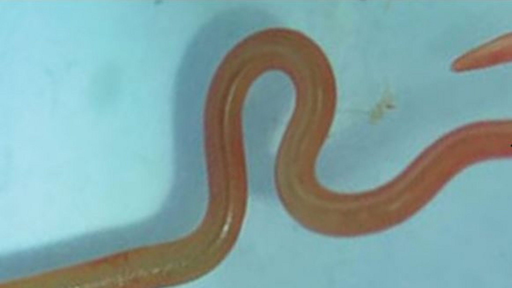 Živi crv prvi put izvađen iz ljudskog mozga