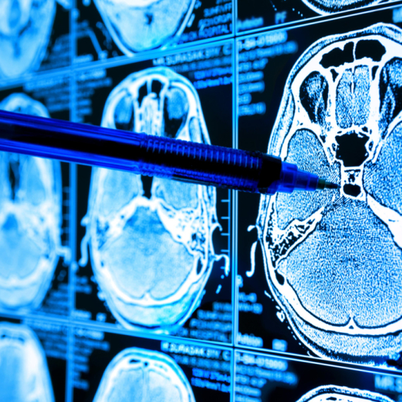 Svaka nova memorija oštećuje moždane ćelije