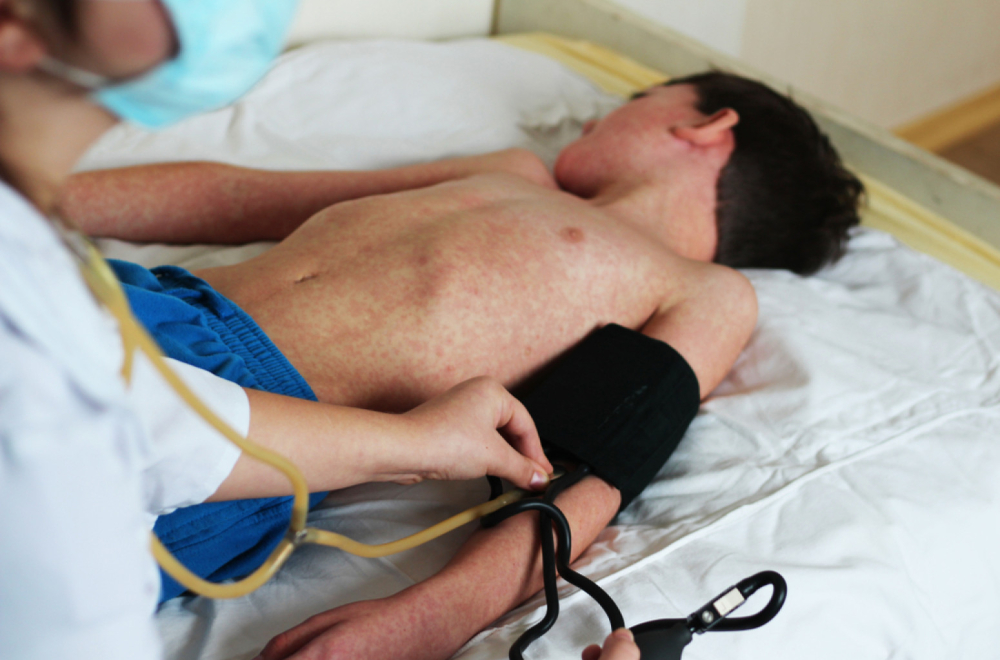 Dvoje umrlo, puno zaraženih, a lekari tvrde – epidemija opada