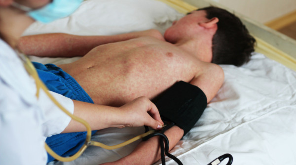 Bukti epidemija morbila u komšiluku: Većina zaraženih deca