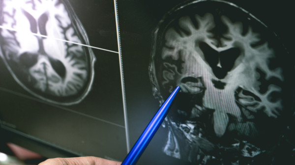 Nova terapija može odložiti Alchajmerovu bolest i to za sedam godina