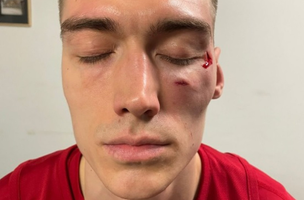 Lice Stefana Lazarevića posle napada Džejmsa Nanelija FOTO