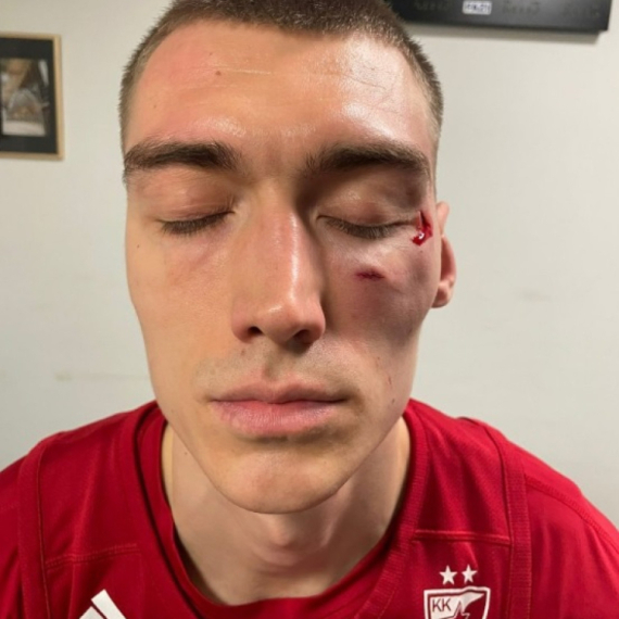 Lice Stefana Lazarevića posle napada Džejmsa Nanelija FOTO