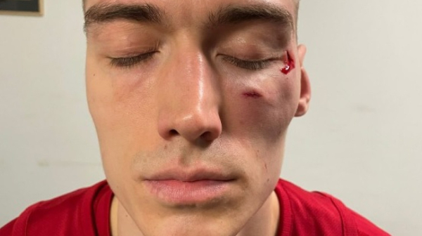 Lice Stefana Lazarevića posle napada Džejmsa Nanelija FOTO