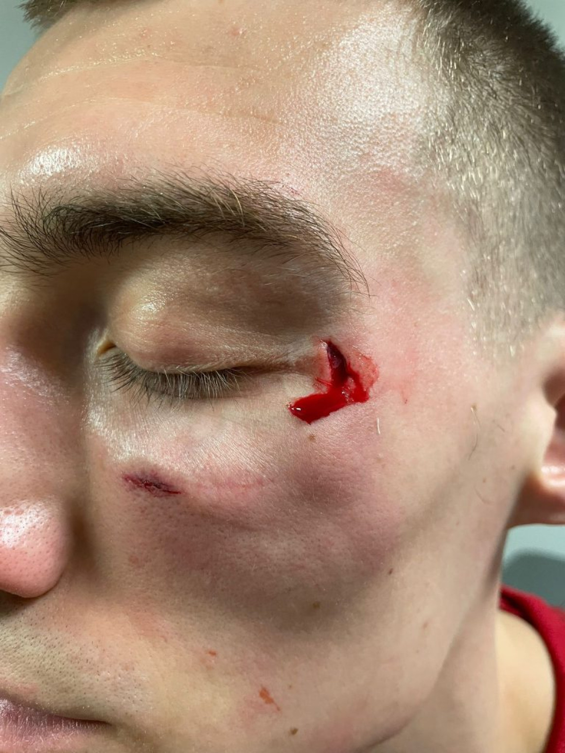 Lice Stefana Lazarevića posle napada Džejmsa Nanelija FOTO