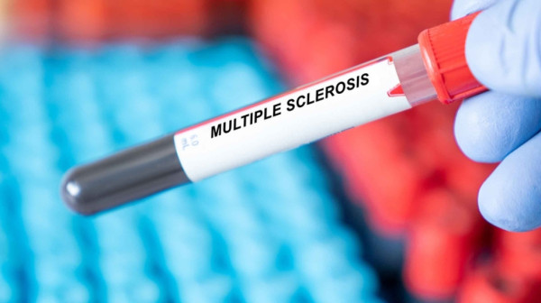 U Srbiji oko 9.000 ljudi boluje od multiple skleroze: Jedna stvar je ključna