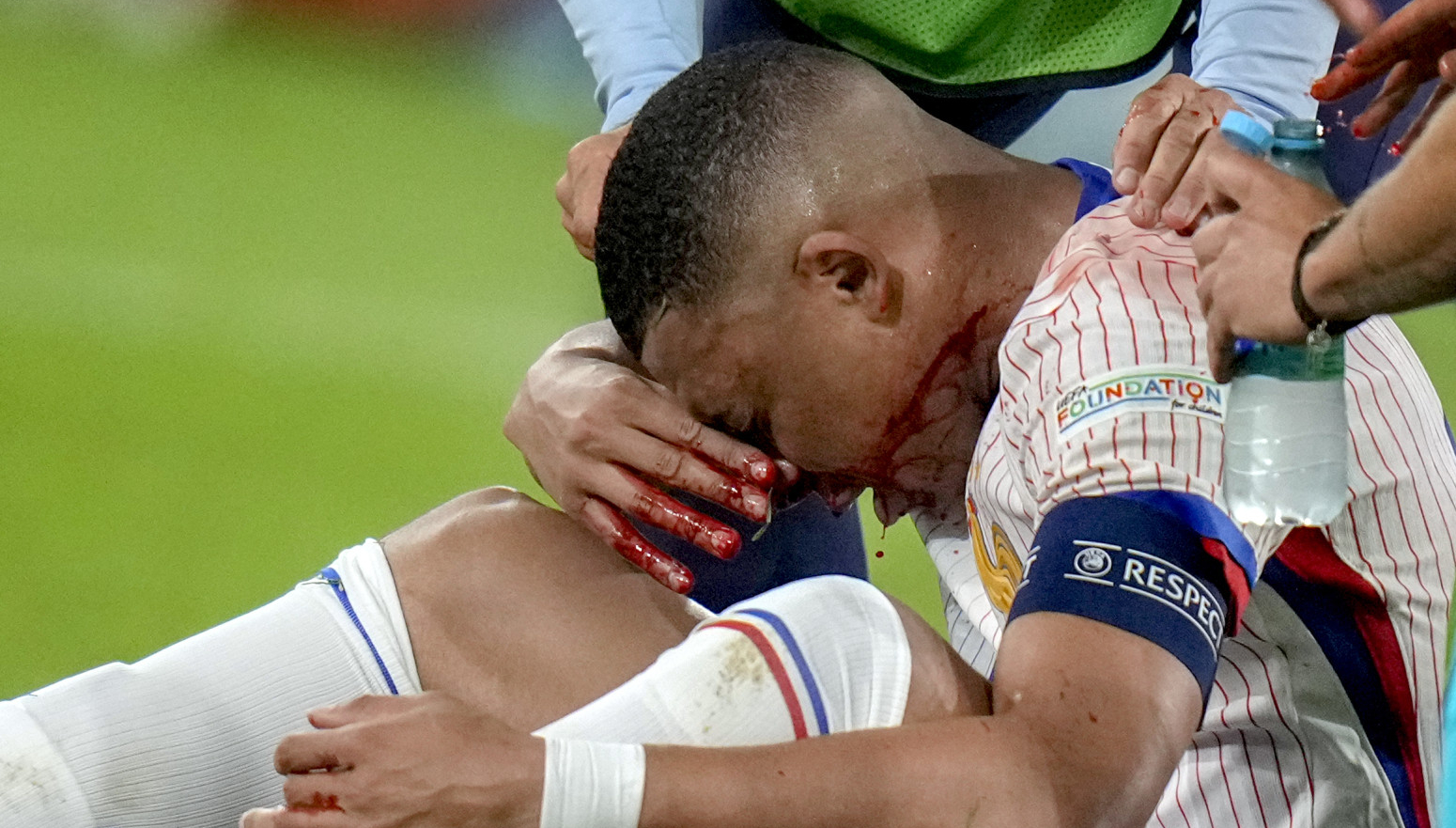 Mbape mora na operaciju!