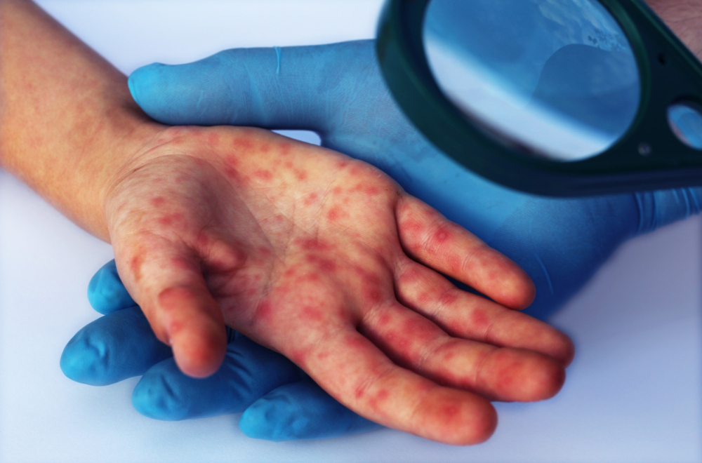 Kako razlikovati boginje kod dece? Ovo morate da znate