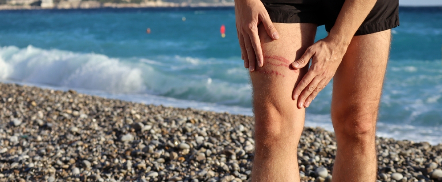 Omiljena letovališta Srba u Grčkoj pod invazijom: "Ubod je jak, bolan i opasan"