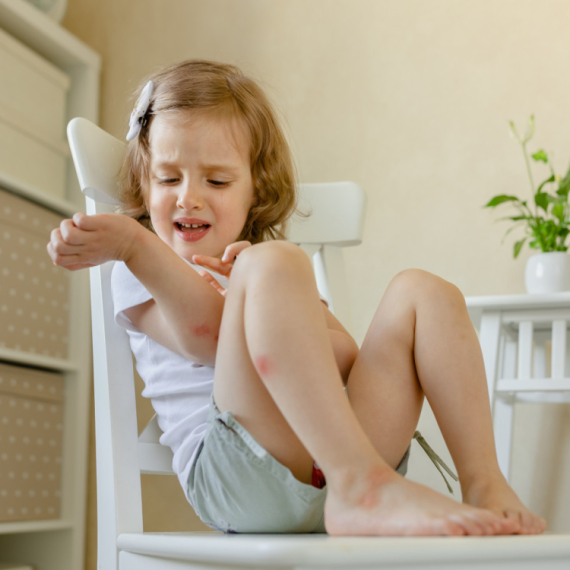 Kako pomoći detetu kod ujeda komarca: Ublažite svrab i otok uz ove korake