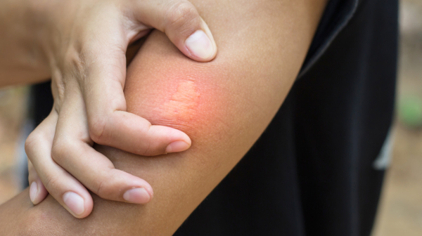 Pčelinji ubod leči neke od najtežih bolesti: Nutricioinista savetuje oprez na jednu stvar VIDEO