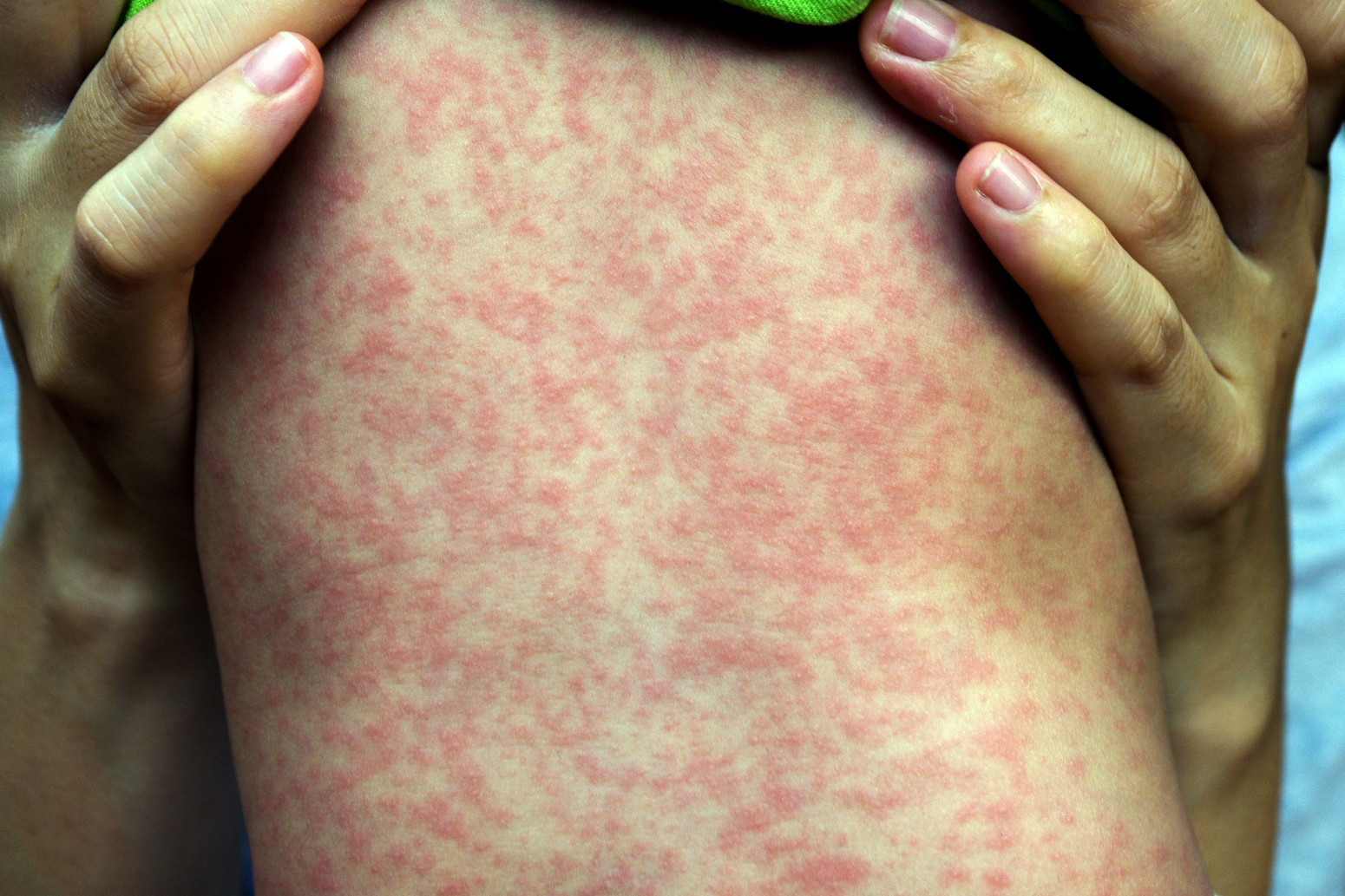 Virus opet zabrinjava: Kako da prepoznate male boginje?
