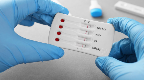 Više od polovine HIV dijagnoza u Evropi postavlja se prekasno