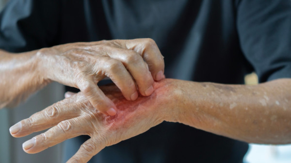 U Dubrovniku zabeležena tri slučaja šuge