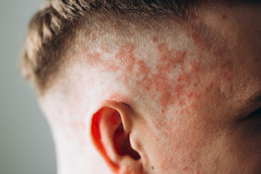 Sunce i muke s psorijazom: Spas u biološkoj terapiji