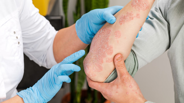 Zajedno protiv psorijaze: Edukacija i podrška na Svetski dan borbe