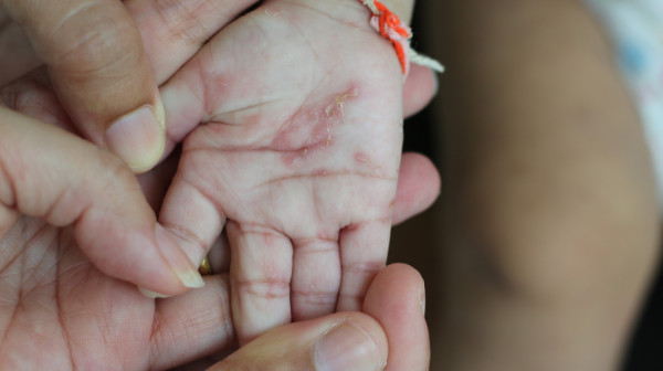 Ovo su glavni znaci oboljenja: Zaraza se širi Beogradom