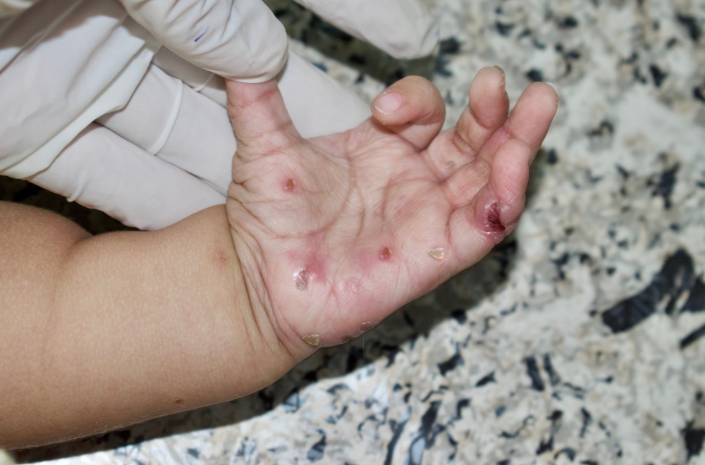 Šuga i u Beogradu: Zaraza se širi Srbijom, doktorka upozorava na mere