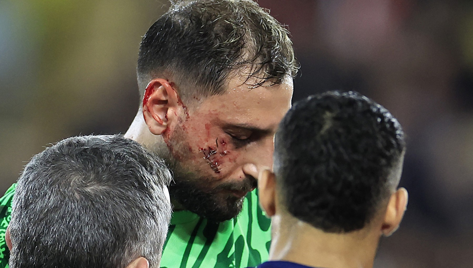 Uznemirujuće slike – Donarumi unakaženo lice FOTO/VIDEO