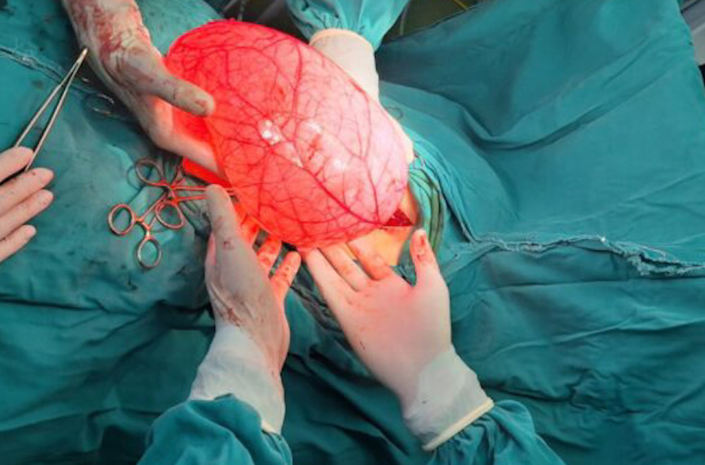 Bila na dijeti, a stomak joj rastao: Devojčici uklonjen tumor od četiri kilograma FOTO