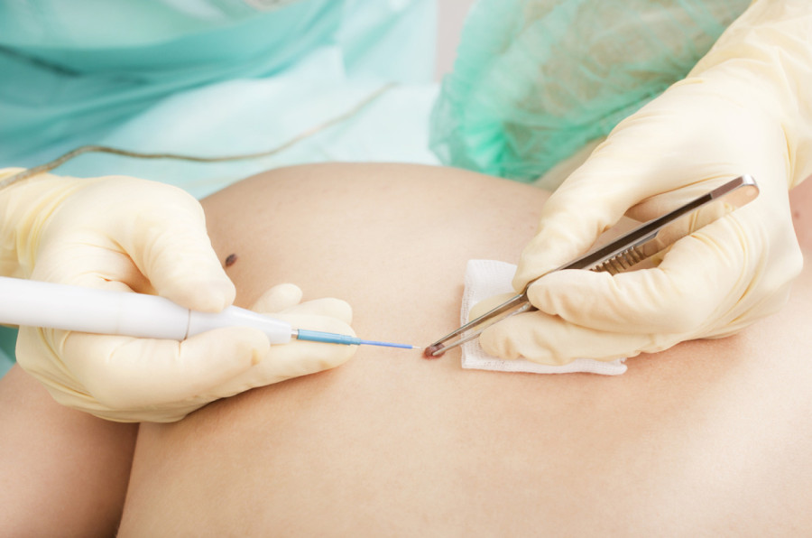 Sve o ruskoj vakcini protiv raka: Stručnjaci otkrivaju ima li nade za univerzalni lek