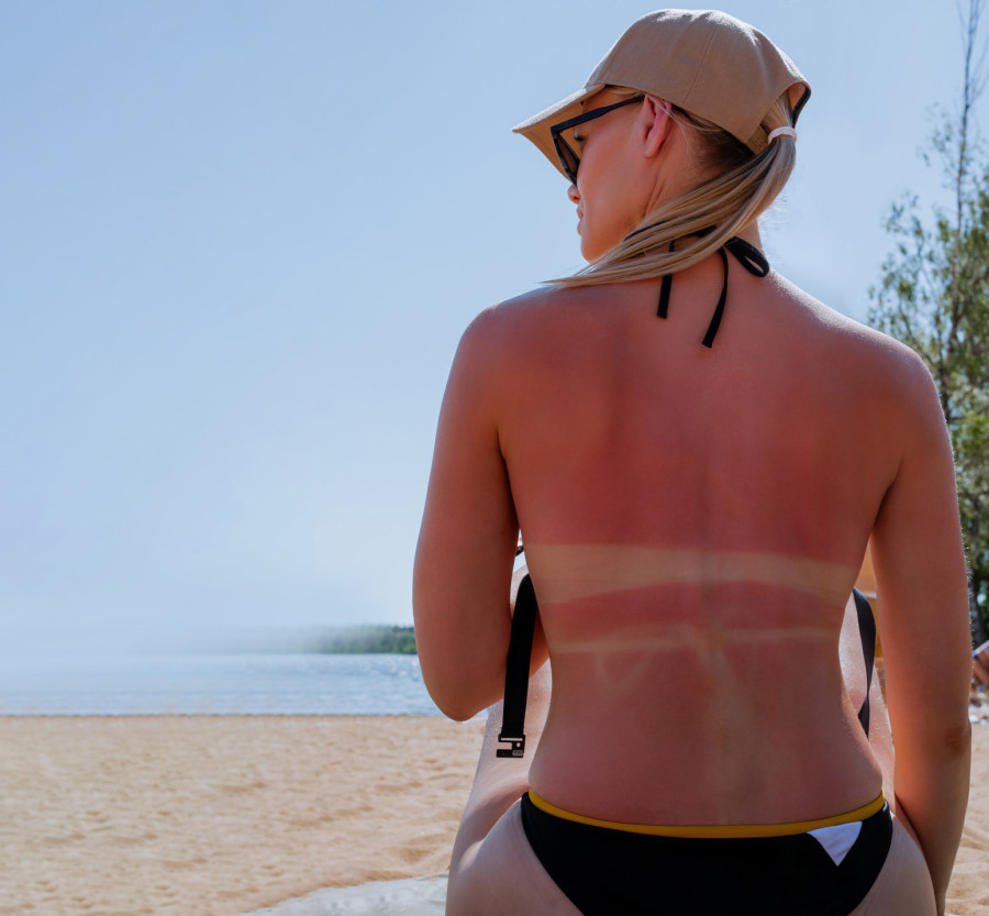 Niste ni svesni koliko je sunce opasno: U Srbiji otkriveno 700 melanoma za godinu dana VIDEO