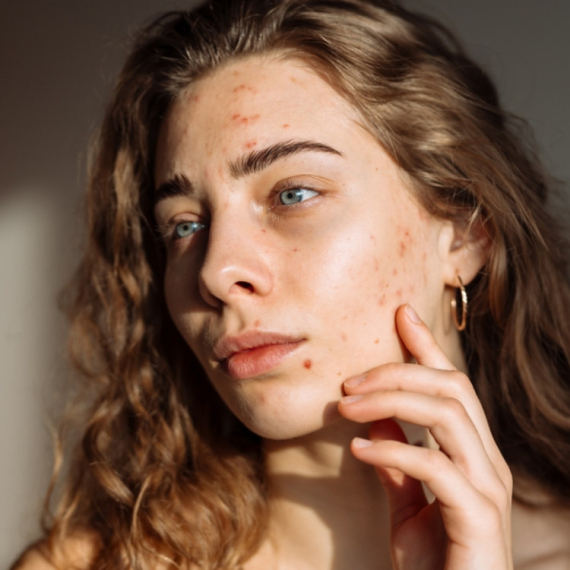 Kakve probleme izaziva maslinovo ulje na koži?