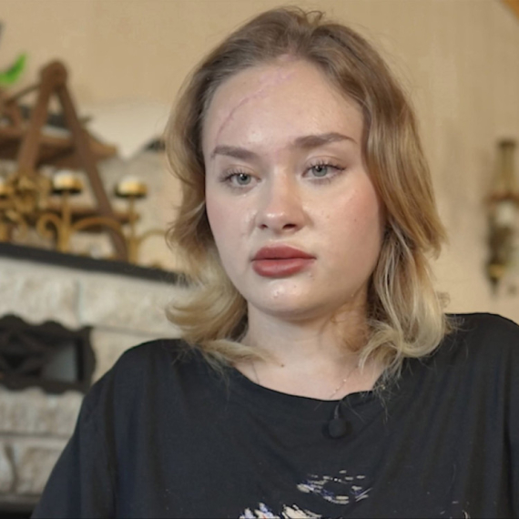 Marija Kovalčuk priznala da je lagala: Nakon što je unakažena u Dubaiju iznela novu priču FOTO