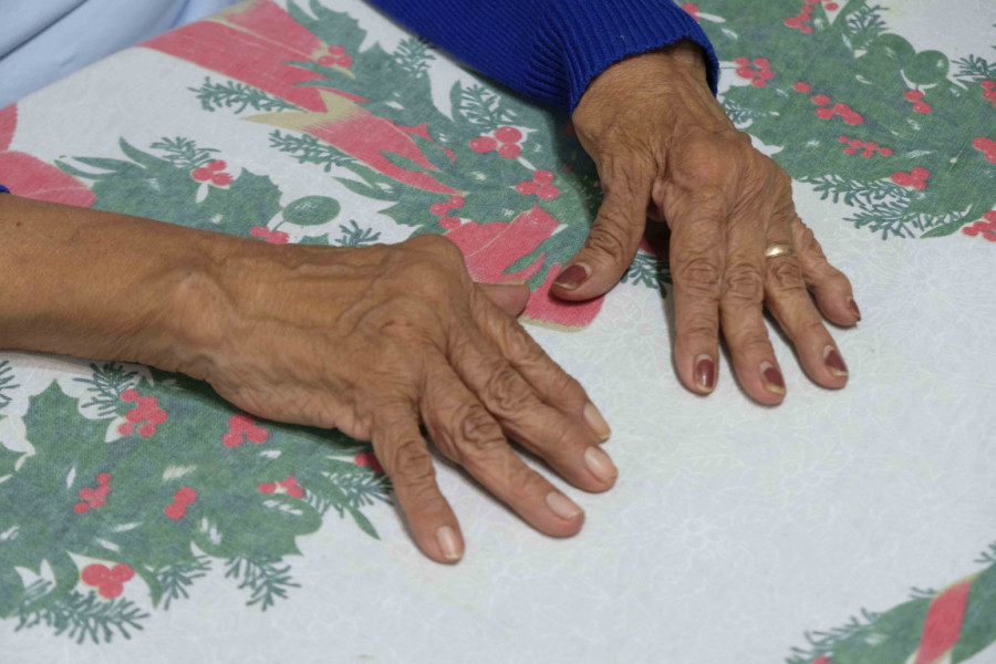 Više od bola u zglobovima: Prepoznajte rane znake bolesti koja okupira više organa