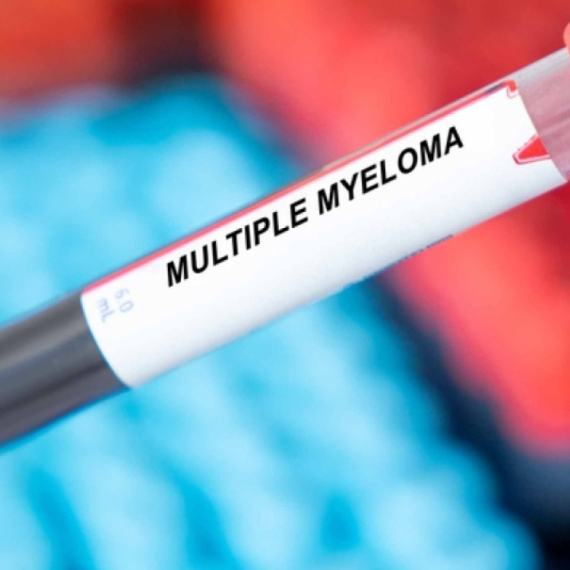 Dijagnozu multiplog mijeloma, raka krvi, godišnje dobije 500 ljudi u Srbiji