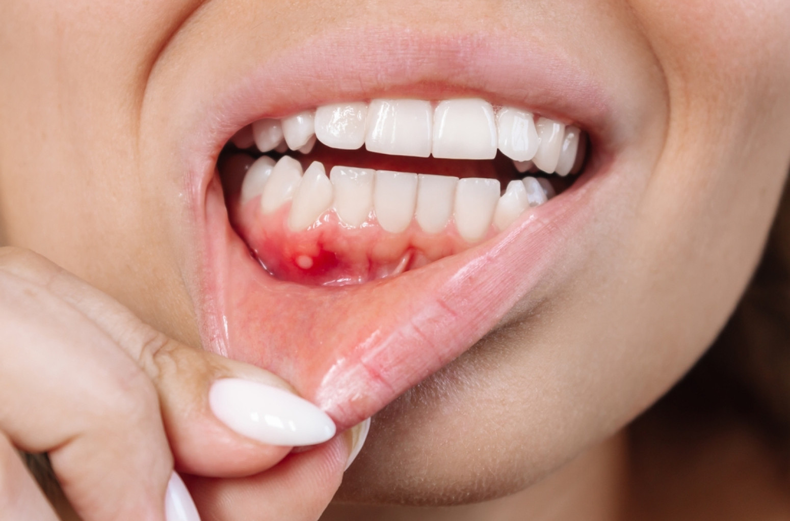 Ova namirnica utiče na zdravlje desni: Izaziva parodontopatiju FOTO