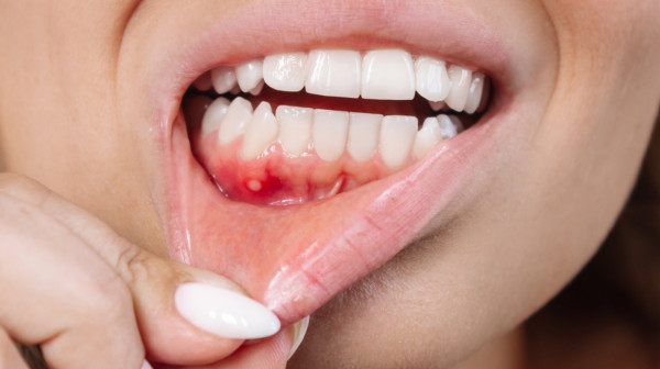 Ova namirnica utiče na zdravlje desni: Izaziva parodontopatiju FOTO