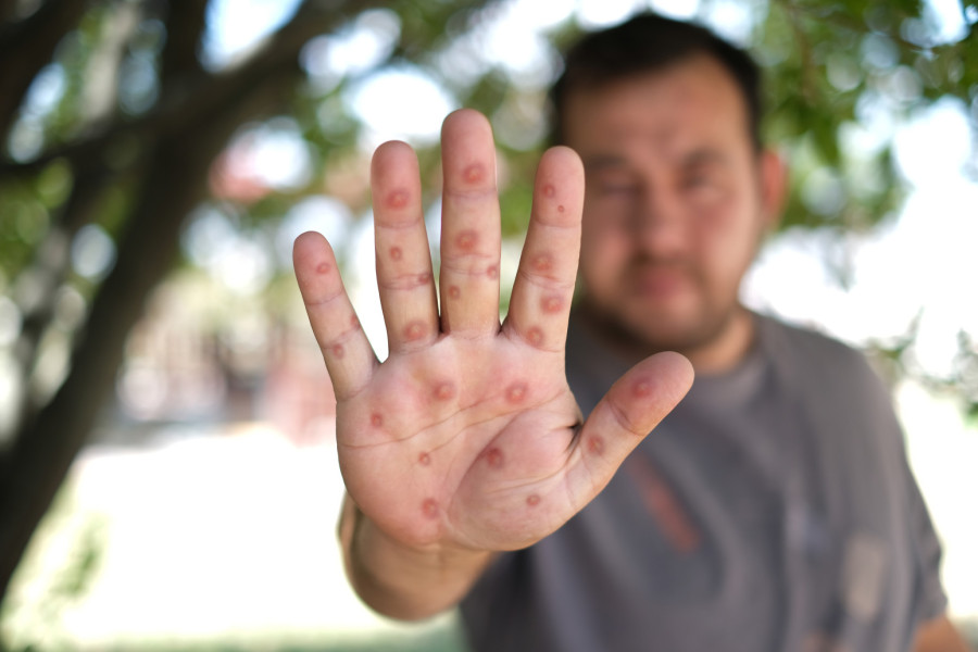 Širi se, ne dopustite da vas iznenadi epidemija