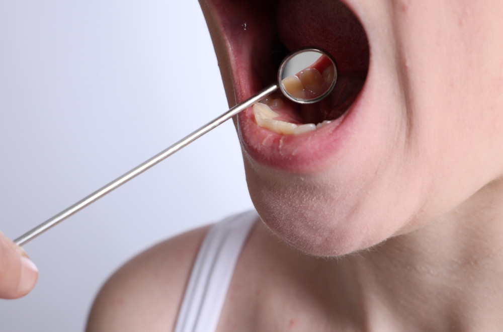 Ovih 5 loših navika drastično povećavaju rizik za nastanak kancera usne duplje