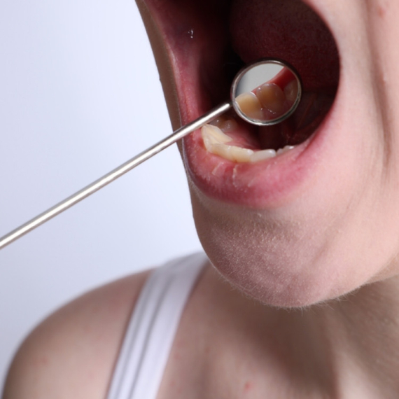 Ovih 5 loših navika drastično povećavaju rizik za nastanak kancera usne duplje