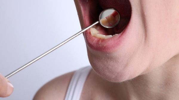 Ovih 5 loših navika drastično povećavaju rizik za nastanak kancera usne duplje