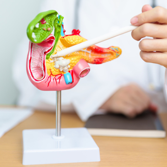 Ne ignorišite ove znakove: Lekari upozoravaju na skrivene simptome raka pankreasa