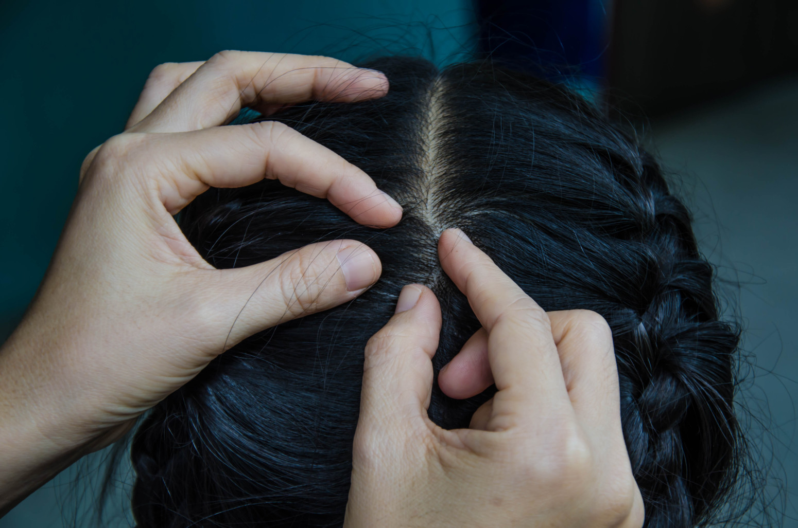 Deca imaju rane na glavi: Problem sa vaškama u Beogradu, oglasio se Gradski zavod za javno zdravlje