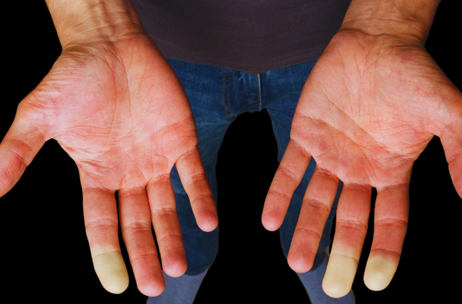 Hladne su vam ruke i stopala: Možda imate Rejnoov sindrom FOTO