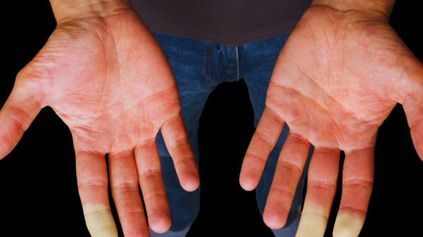 Hladne su vam ruke i stopala: Možda imate Rejnoov sindrom FOTO