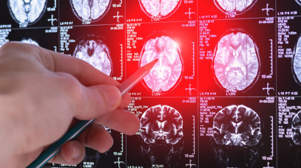 Nije svaka glavobolja rak mozga: Lekar upozorava kada je vreme da potražite pomoć