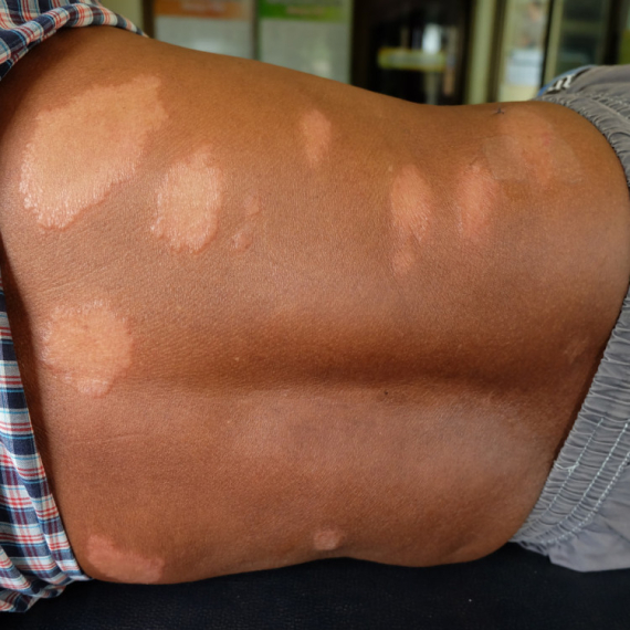 Poznato stanje pacijenta zaraženog leprom: Celo telo flekavo, evo da li može doći do epidemije