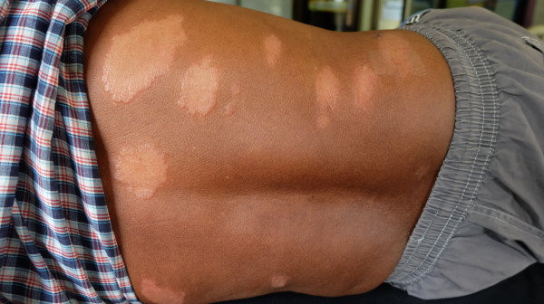 Poznato stanje pacijenta zaraženog leprom: Celo telo flekavo, evo da li može doći do epidemije