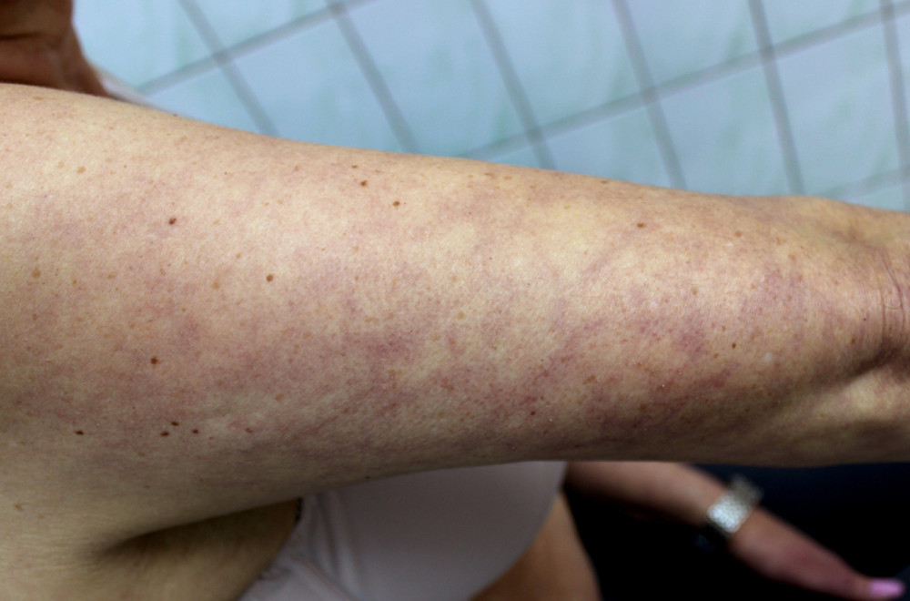 Ove promene na koži mogu ukazivati na opasne kardiovaskularne probleme