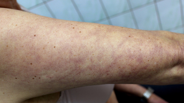 Ove promene na koži mogu ukazivati na opasne kardiovaskularne probleme