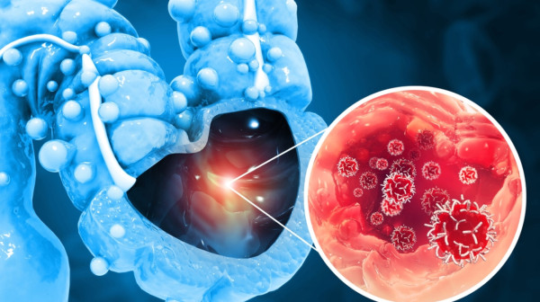 Džejms van der Bik preminuo od raka debelog creva: Kako prepoznati rane znake ove podmukle bolesti