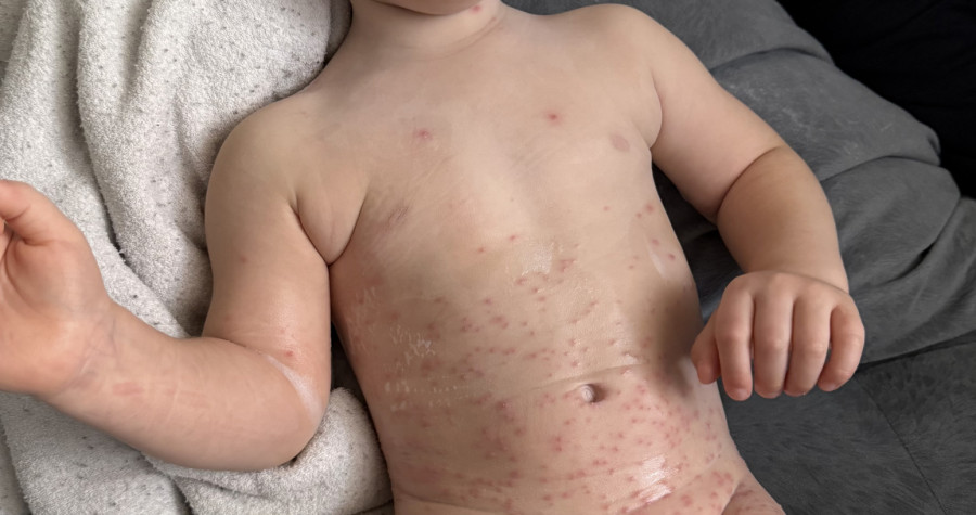 Ovo je jedna od najčešćih bolesti koja se lako prenosi i širi u kolektivima