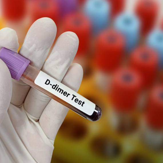 D-dimer test: Šta znači povišen nalaz i kada je vreme za brigu?