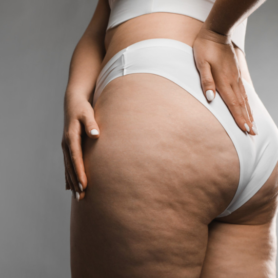 Ne trebaju vam skupe kreme: Ova hrana uništava celulit brže od bilo kojeg tretmana